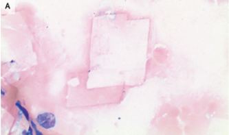 コレステロール心膜炎：関節リウマチ患者に認めた慢性心嚢液貯留（コルヒチンにより治療）のアイキャッチ画像