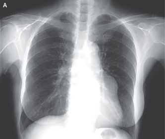 巨大冠動脈瘤:ECG正常。冠動脈CTにて動脈瘤確認症例です。のアイキャッチ画像