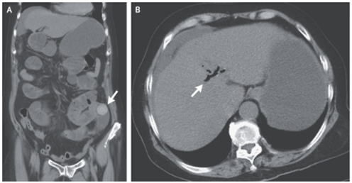 胆石性イレウス：異所性胆石、小腸閉塞、胆管気腫症から診断のアイキャッチ画像