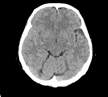 頭部メジャー疾患の非典型例：クモ膜下出血のアイキャッチ画像