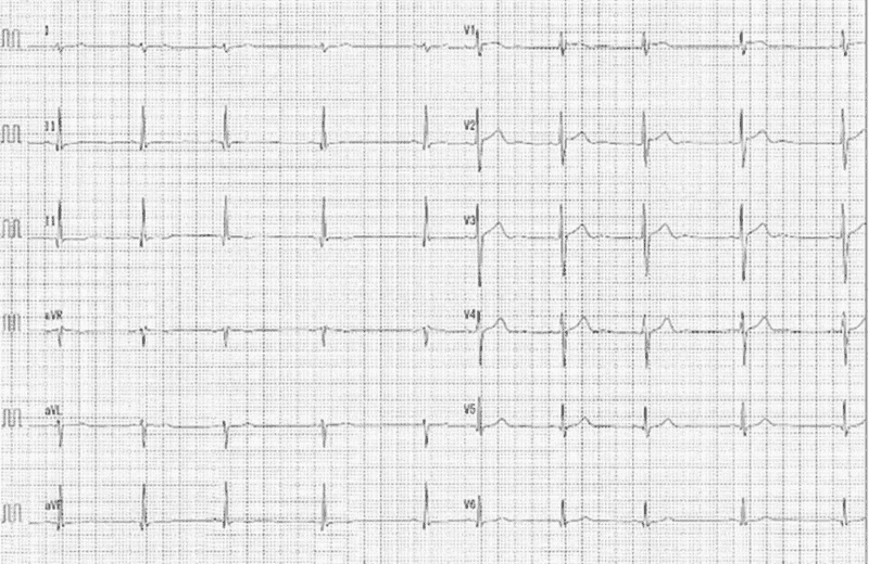 心電図の読み方7　予後良好な早期再分極症例のアイキャッチ画像