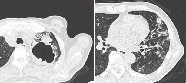 発熱・咳嗽の診察で気をつける疾患:肺結核のアイキャッチ画像