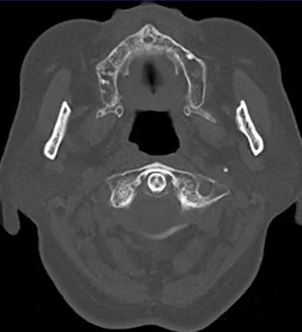 Crowned dens syndrome症例のアイキャッチ画像