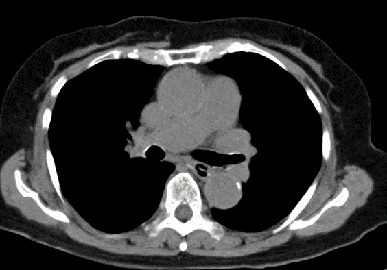 PTP包装シート誤飲のアイキャッチ画像