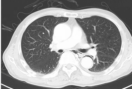 特発性食道破裂の一例のアイキャッチ画像