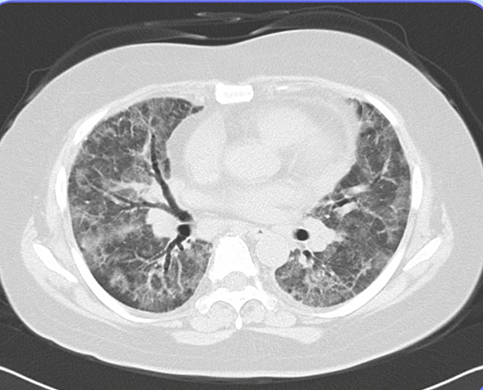 メソトレキセート（MTX）肺炎のアイキャッチ画像