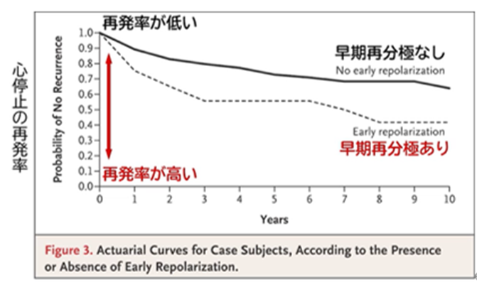 心電図の読み方8　予後不良の早期再分極のアイキャッチ画像