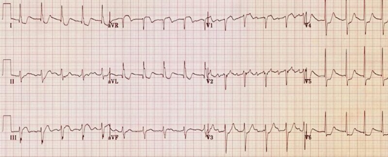心電図の読み方10　左右非対称性のST低下（圧負荷）と見誤ってはいけない症例。左主管部病変の一例。のアイキャッチ画像