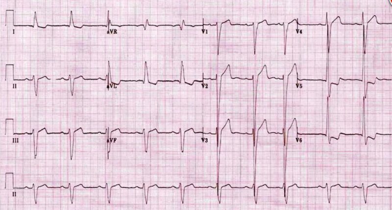 心電図の読み方9　左右非対称性の陰性T波（圧負荷）の症例のアイキャッチ画像