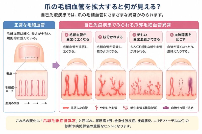 多発筋炎とは？のアイキャッチ画像