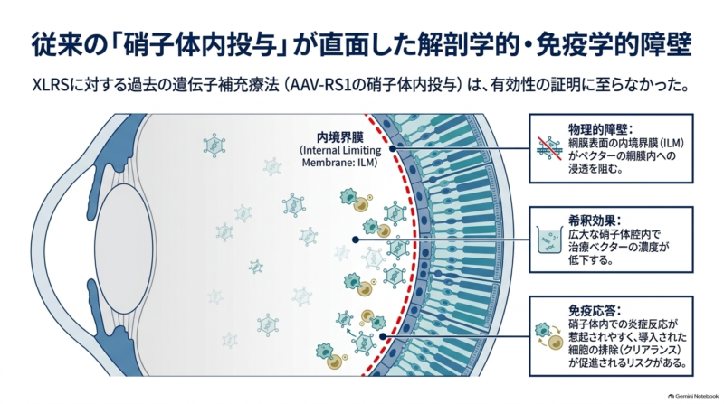 NEJM2026】X連鎖性若年網膜分離症（XLRS）への網膜下AAV8遺伝子治療