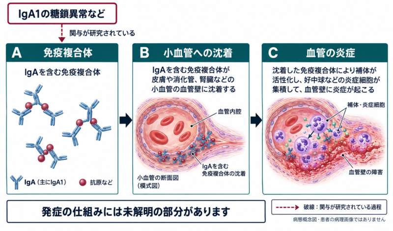 IgA血管炎の症状・原因・治療|大人と子どもの違い、紫斑と腎障害のアイキャッチ画像
