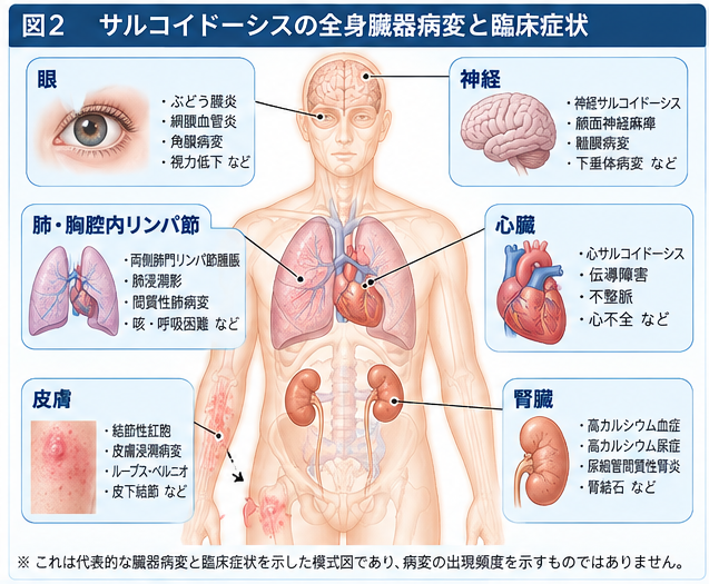 サルコイドーシスによる肺、眼、心臓、神経、皮膚、腎臓の病変を示した全身図