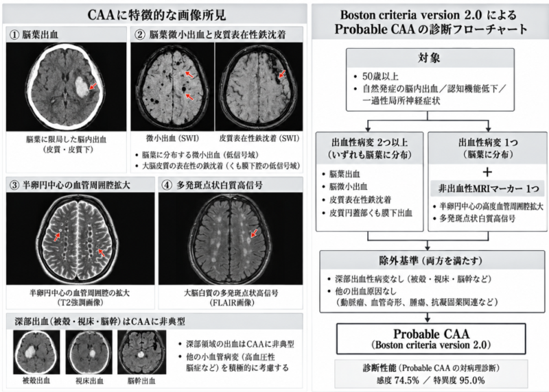 脳葉微小出血、皮質表在性鉄沈着、白質病変を用いたBoston criteria version 2.0のCAA診断フローチャート