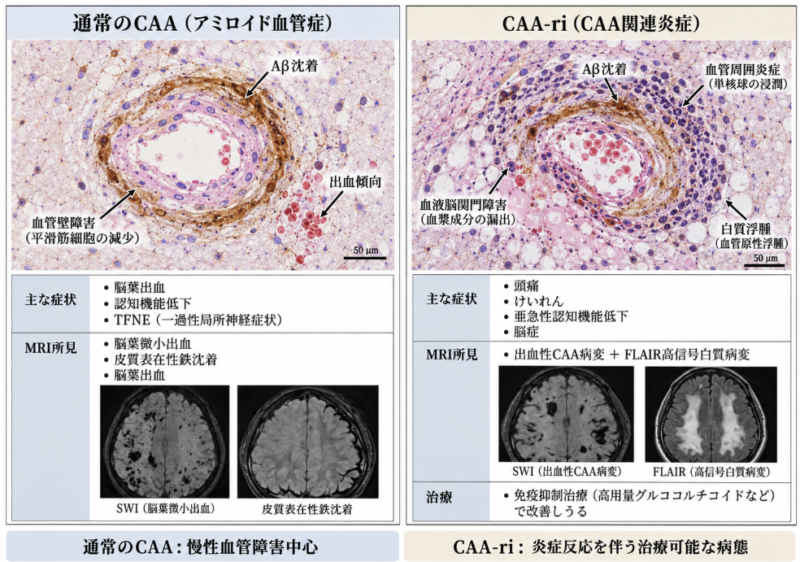 通常のCAAとCAA関連炎症における脳血管壁のAβ沈着、炎症細胞浸潤、脳浮腫の比較模式図。