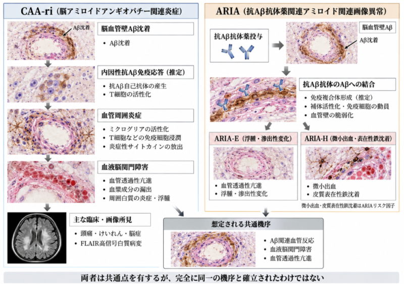 CAA関連炎症と抗アミロイドβ抗体薬によるARIA-E・ARIA-Hの推定病態を比較した医学的模式図。