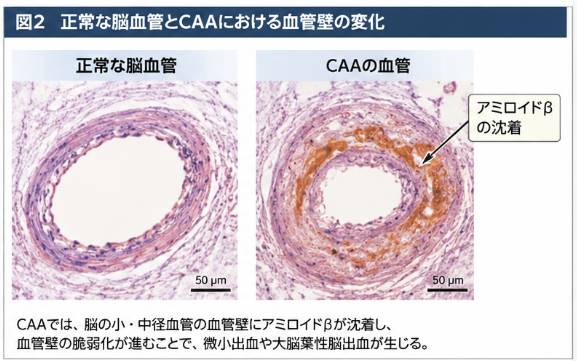 正常な脳血管と脳アミロイドアンギオパチー（CAA）の血管壁を比較した模式図。CAAではアミロイドβが血管壁に沈着し、血管平滑筋細胞の変性や血管壁の脆弱化が生じる。