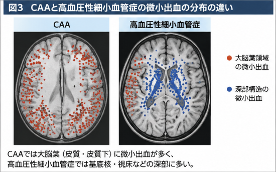 脳微小出血の分布を比較した模式図。CAAでは大脳皮質・皮質下領域に多く、高血圧性細小血管症では基底核・視床などの深部構造に多く認められる。