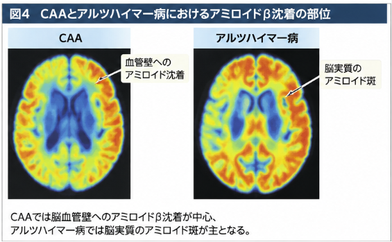 CAAとアルツハイマー病におけるアミロイドβ沈着部位の比較。CAAでは脳血管壁に沈着し、アルツハイマー病では脳実質にアミロイド斑が形成されることを示す模式図。