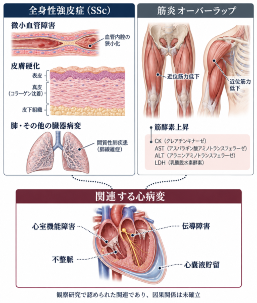 全身性強皮症と筋炎の合併｜心病変のリスクと生命予後を最新研究から解説のアイキャッチ画像