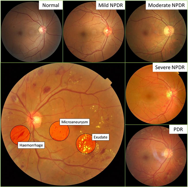 正常眼底から非増殖糖尿病網膜症（NPDR）、増殖糖尿病網膜症（PDR）への病期進行と眼底所見の比較分類図