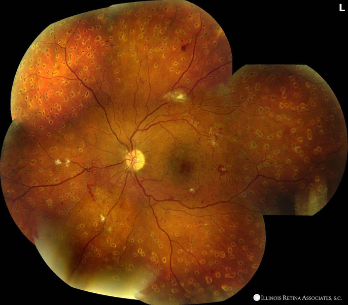 汎網膜光凝固術（Panretinal Photocoagulation：PRP）施行後の眼底所見